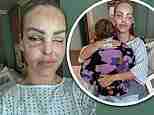 Katie Piper reveals she’s undergone surgery to ‘avoid losing her left eye’ and admits she finds operations ‘mentally hard’ after acid attack ordeal